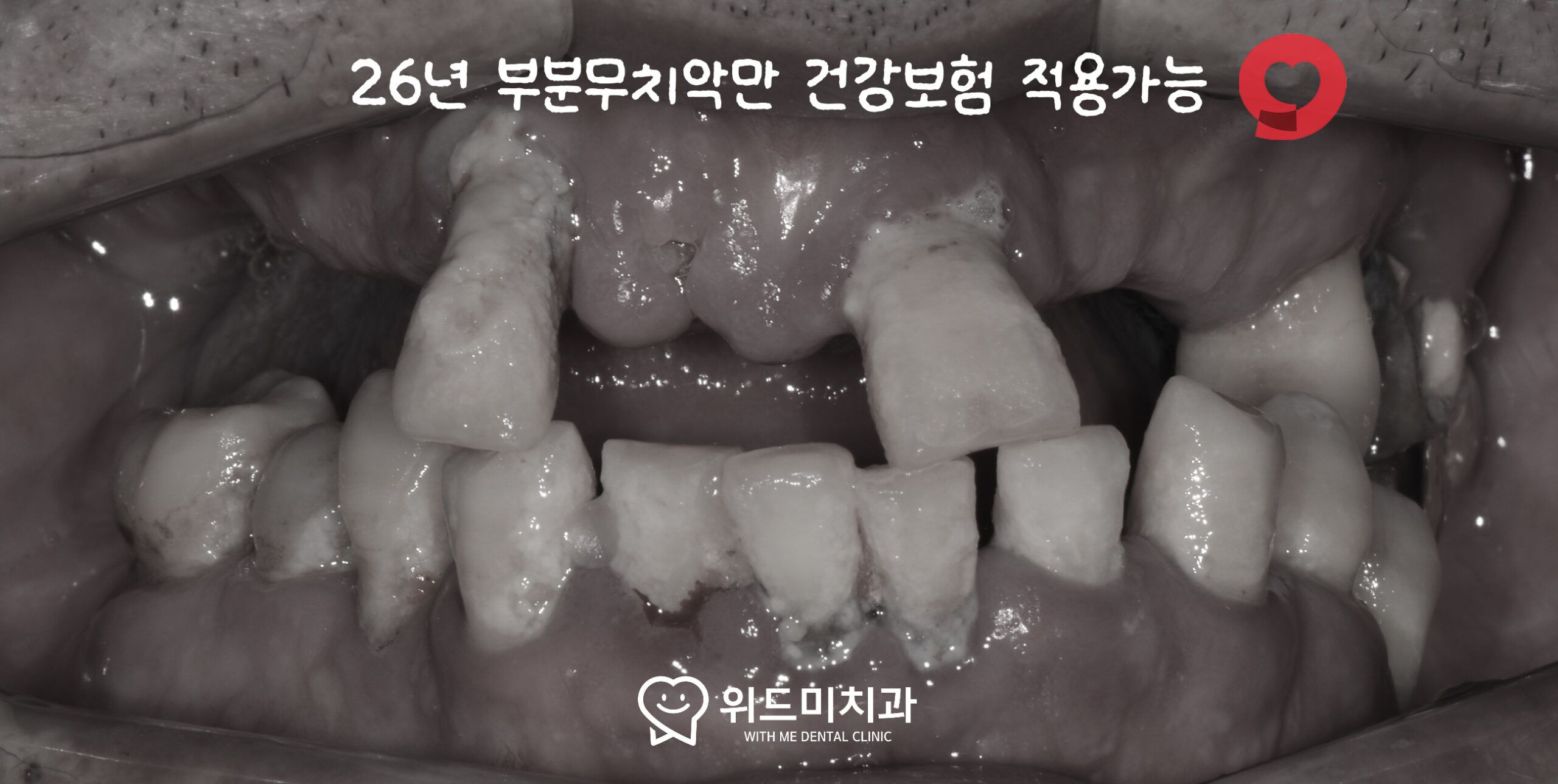 비전동치과 건강보험 임플란트 부분 무치악