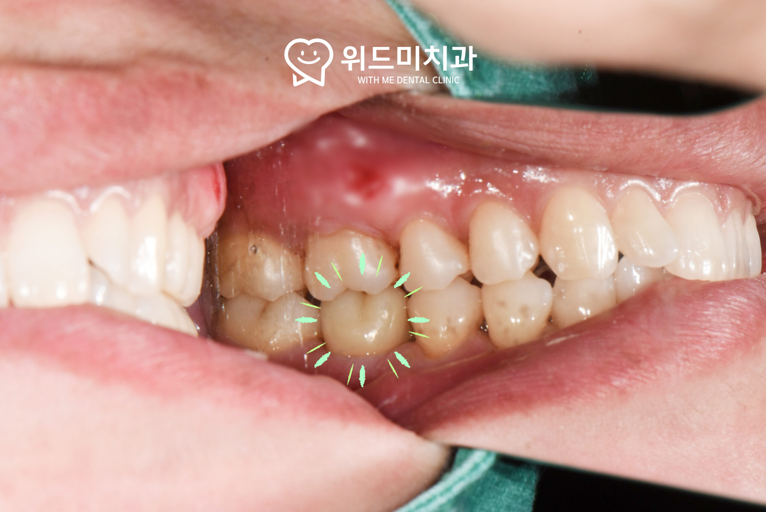비전동치과 임플란트 수술 후