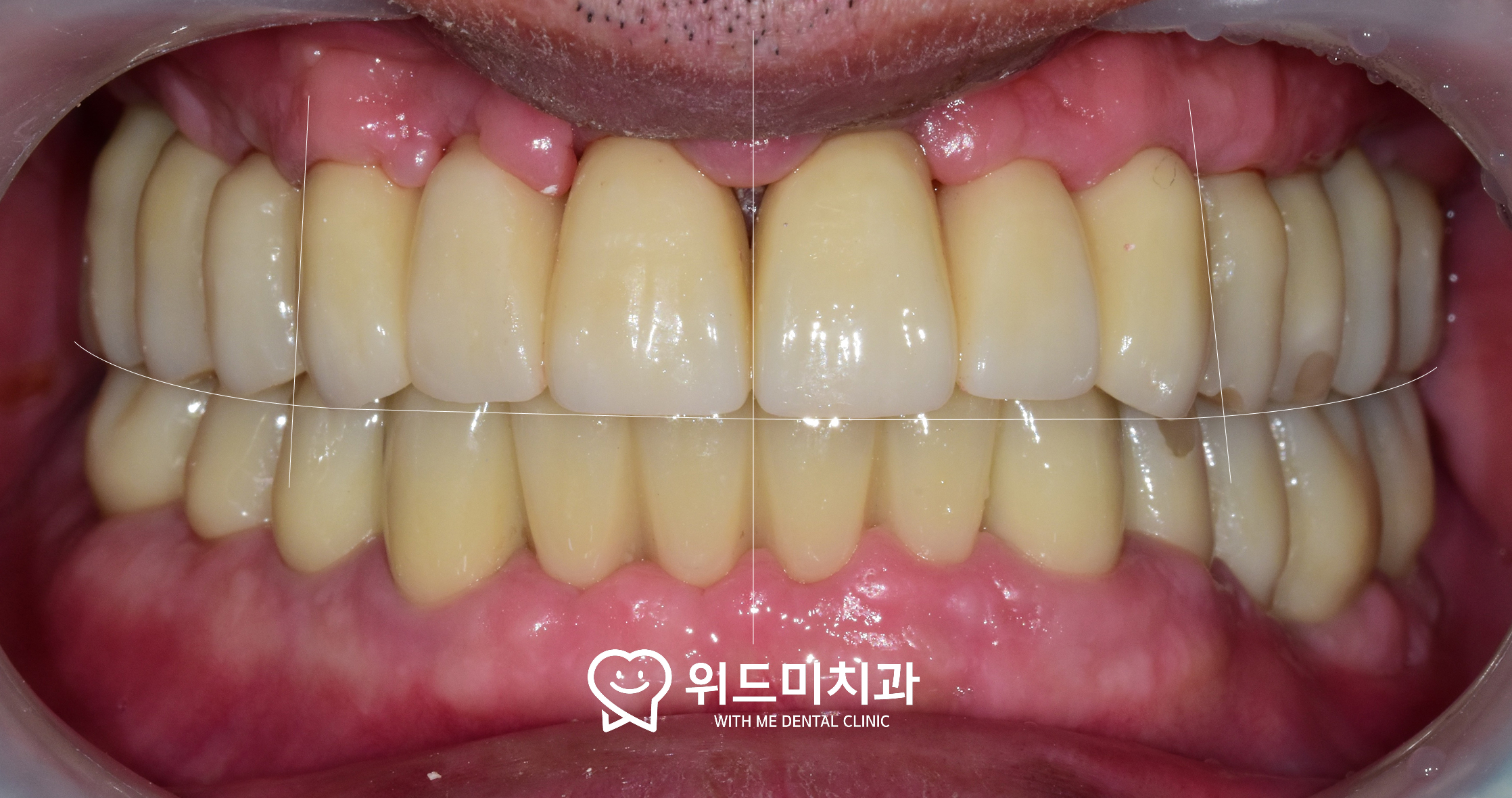 dental implant treatment complete edentulous jaw