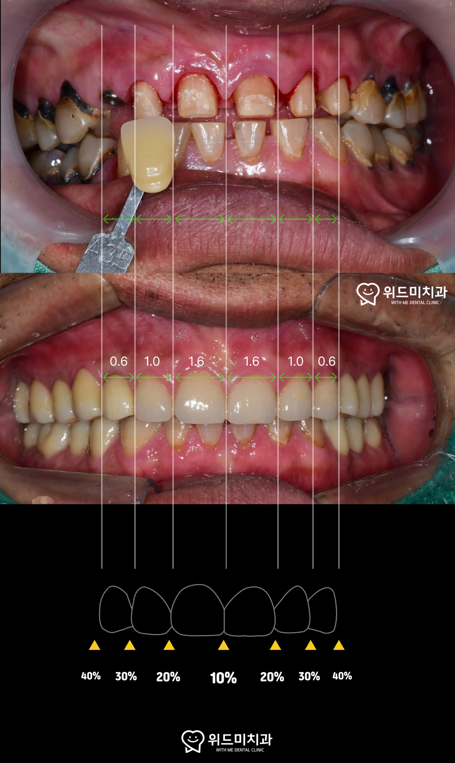gingival contour esthetic dentistry smile line