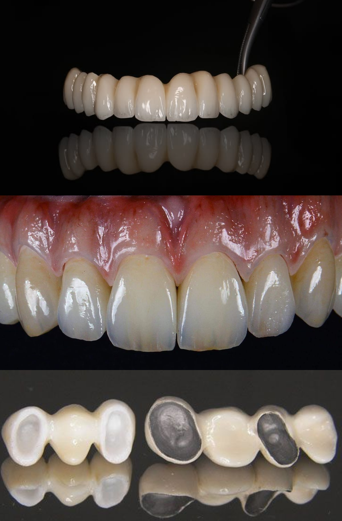 dental occlusion zirconia ceramic crown anterior