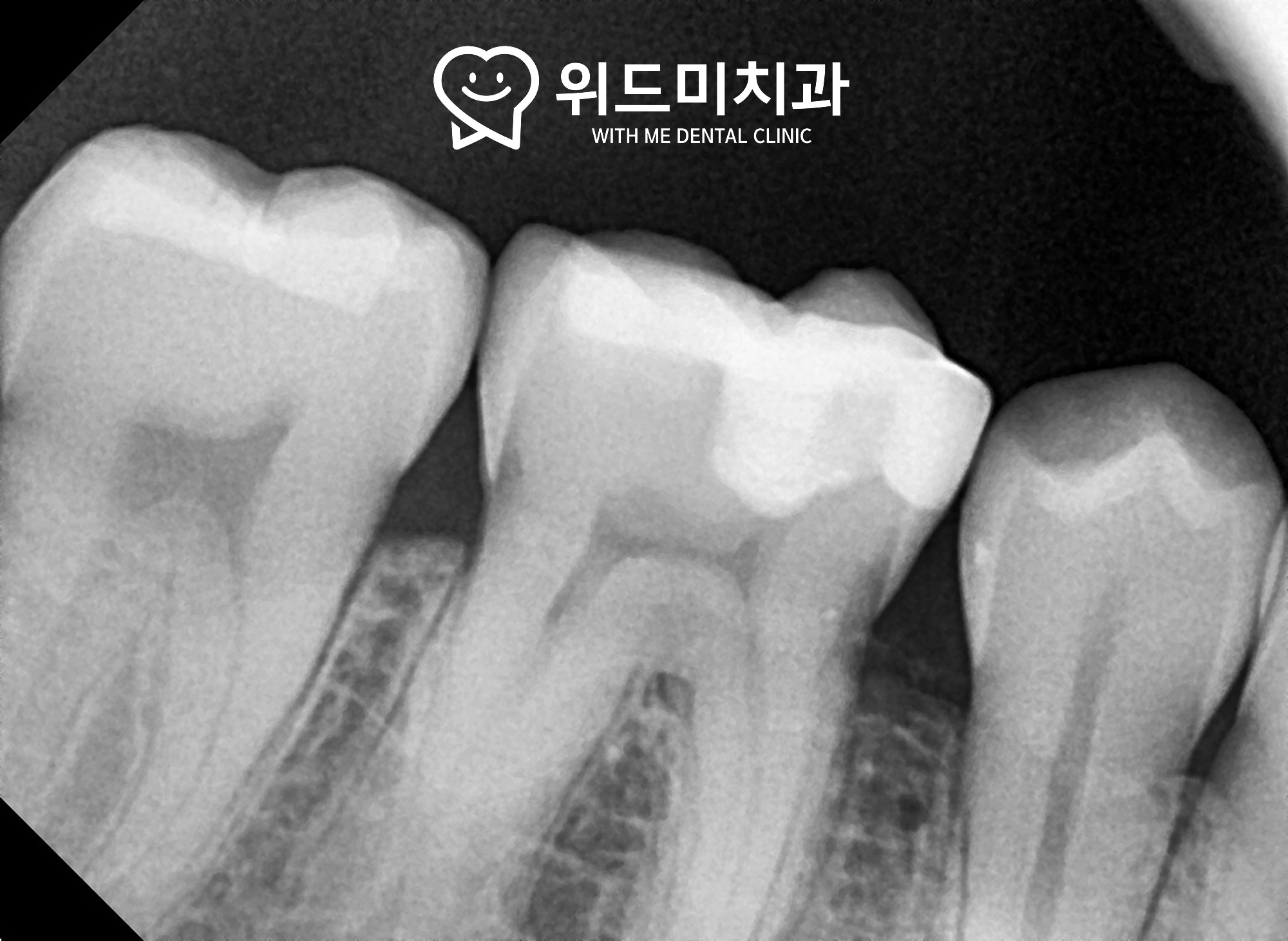 소사동치과 하이브리드 인레이 최종 수복 완료