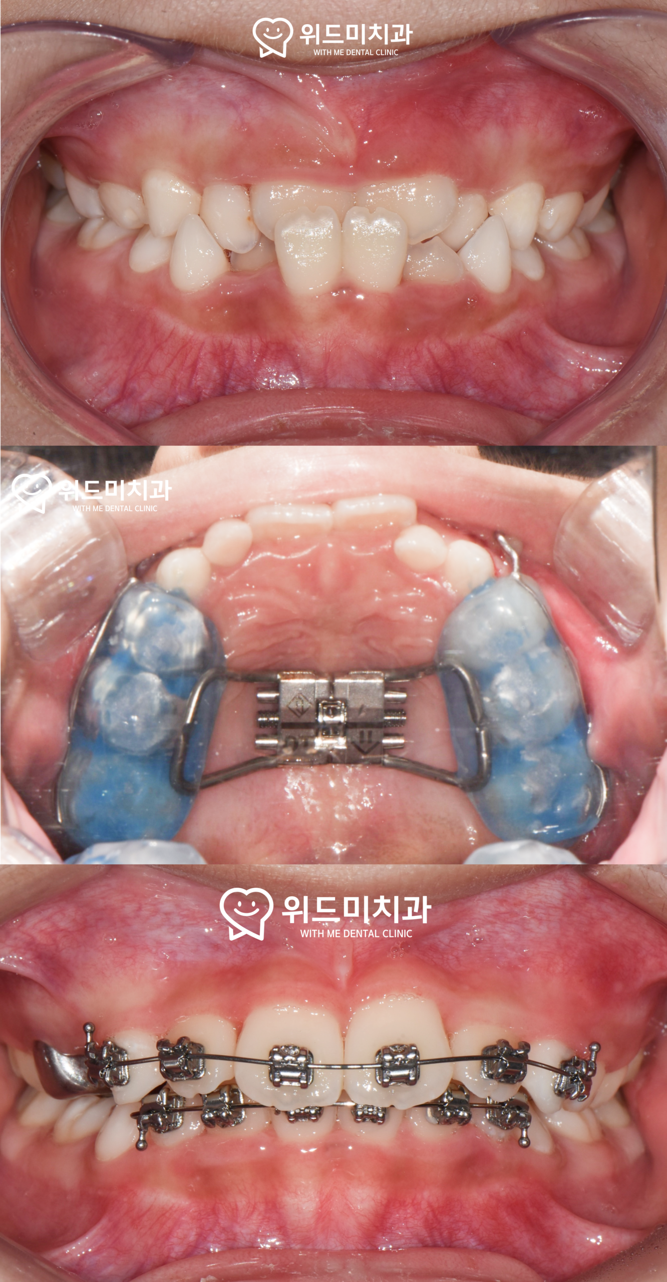 mixed dentition orthodontic timing
